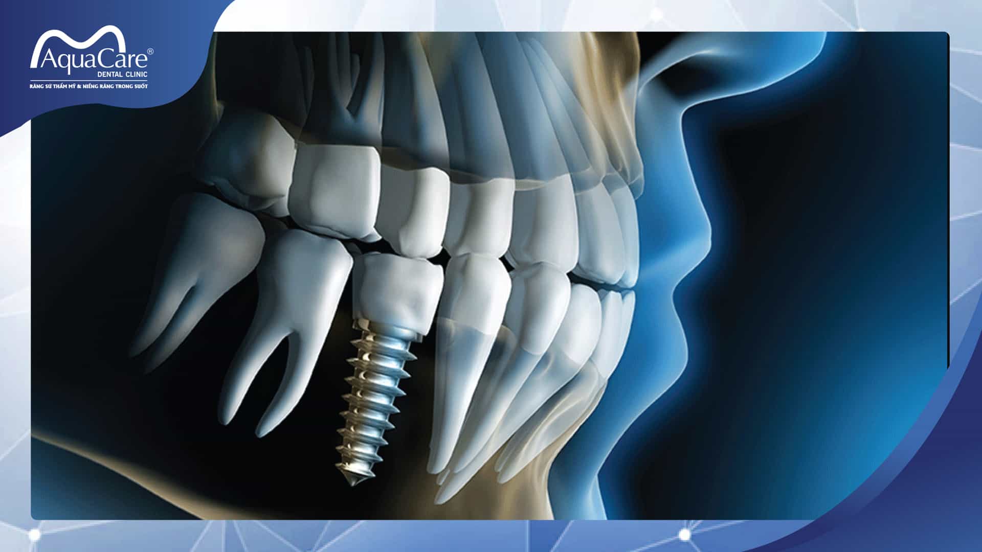 implant dưới màng xương