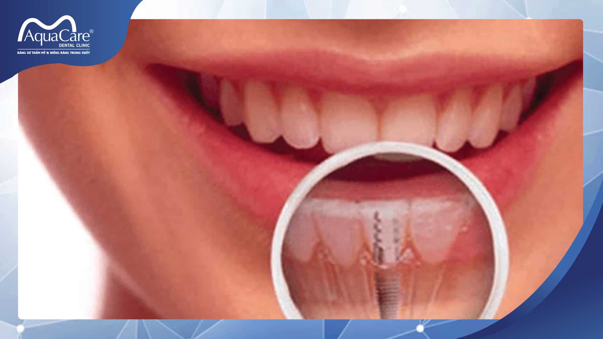 implant là gì?