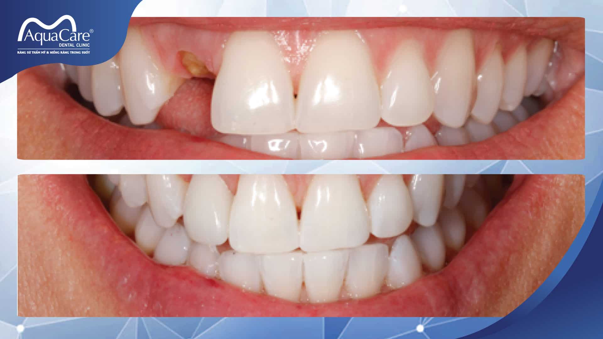 cấy ghép implant rất quan trọng
