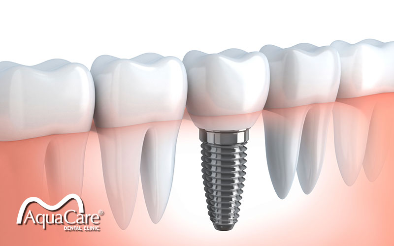 Cay-ghep-implant-co-dau-khong