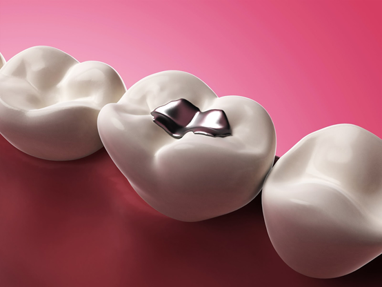 Bạc (Amalgam, Silver)