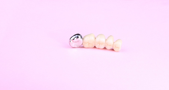 Sử dụng vật liệu nào để hàn răng?