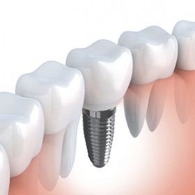 Cấy ghép implant
