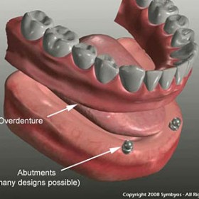 Cấy ghép implant