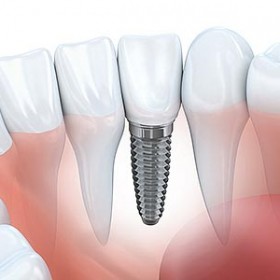 Cấy ghép implant