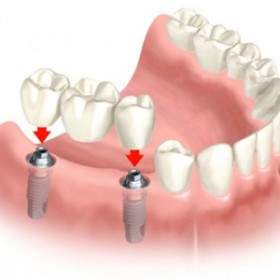Cấy ghép implant