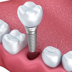 Cấy ghép implant