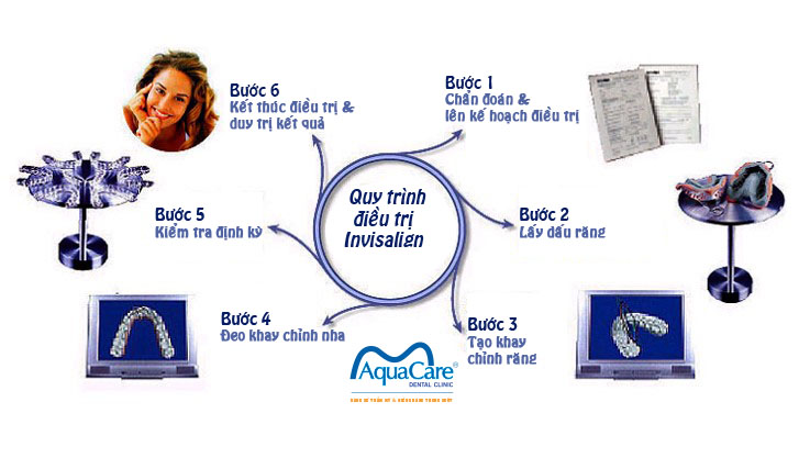 quy-trinh-nieng-rang-trong-suot-invisalign