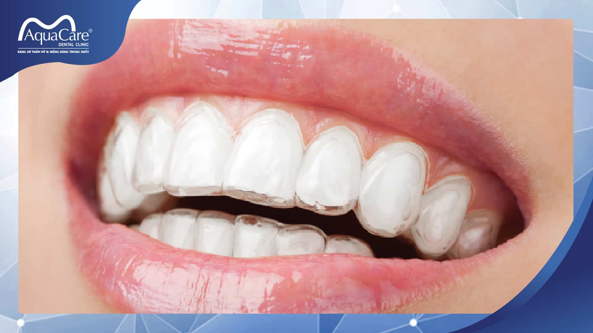 ưu điểm niềng răng invisalign
