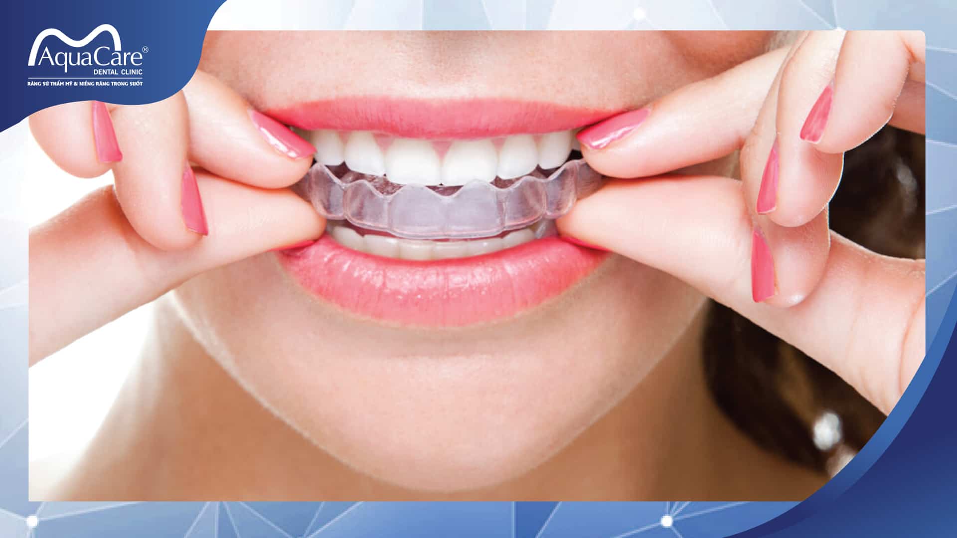 đeo khay trong suốt Invisalign
