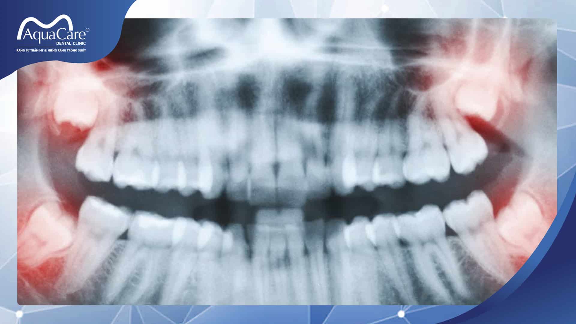 nhổ răng khôn có đau không?