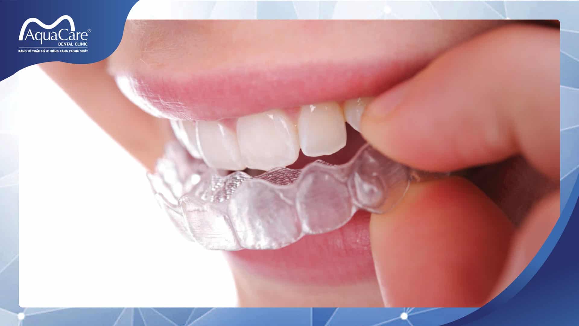 Niềng răng trong suốt và những điều bạn chưa biết